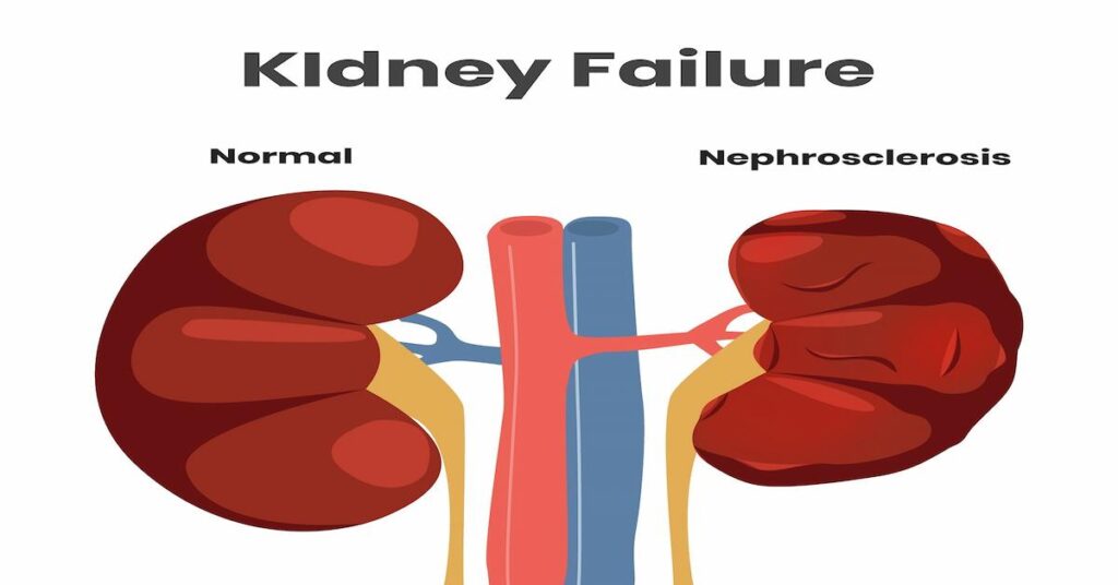 What is Kidney failure Biggest reason your kidneys could be failing